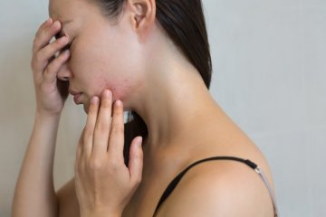 Hormonálne akné. Problém, ktorý má riešenie